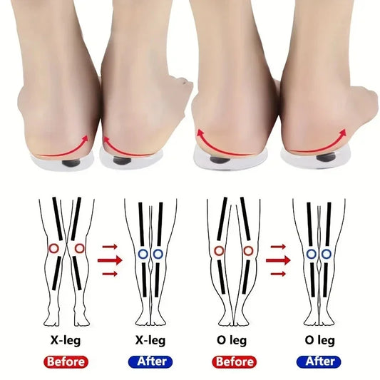 Orthopedic Insoles for Feet OX Leg Valgus Correction